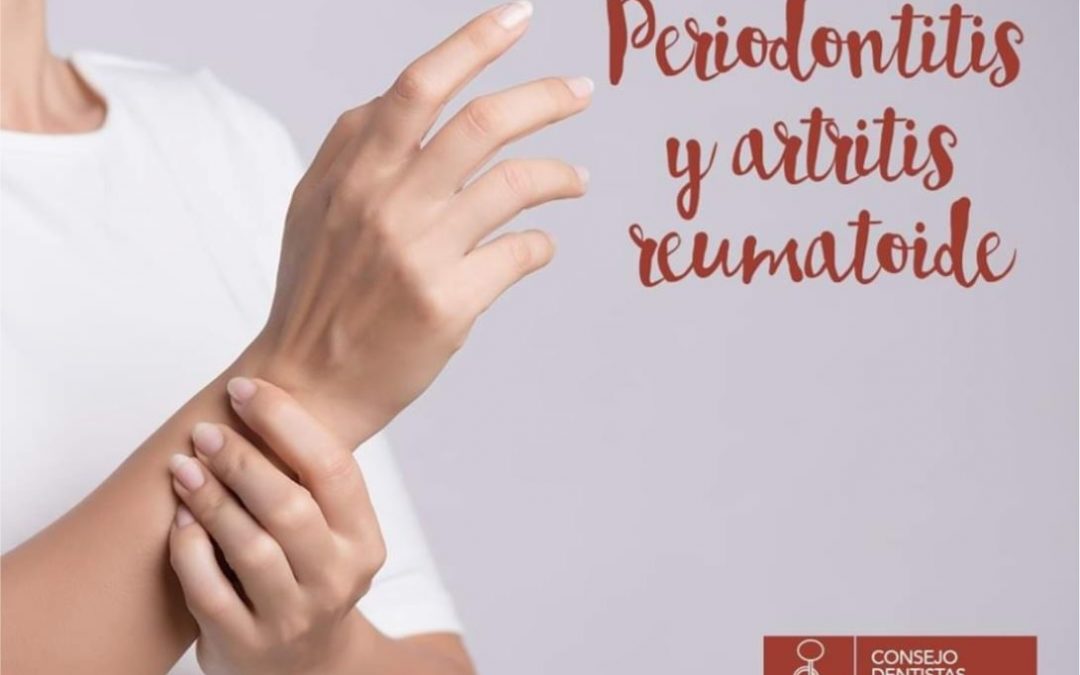 Periodontitis, Artritis reumatoide