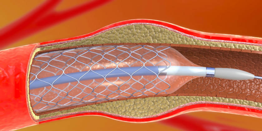 ¿Qué son los stents y para qué se utilizan en cardiología?